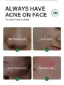 Acne Skin Care Products 30ml