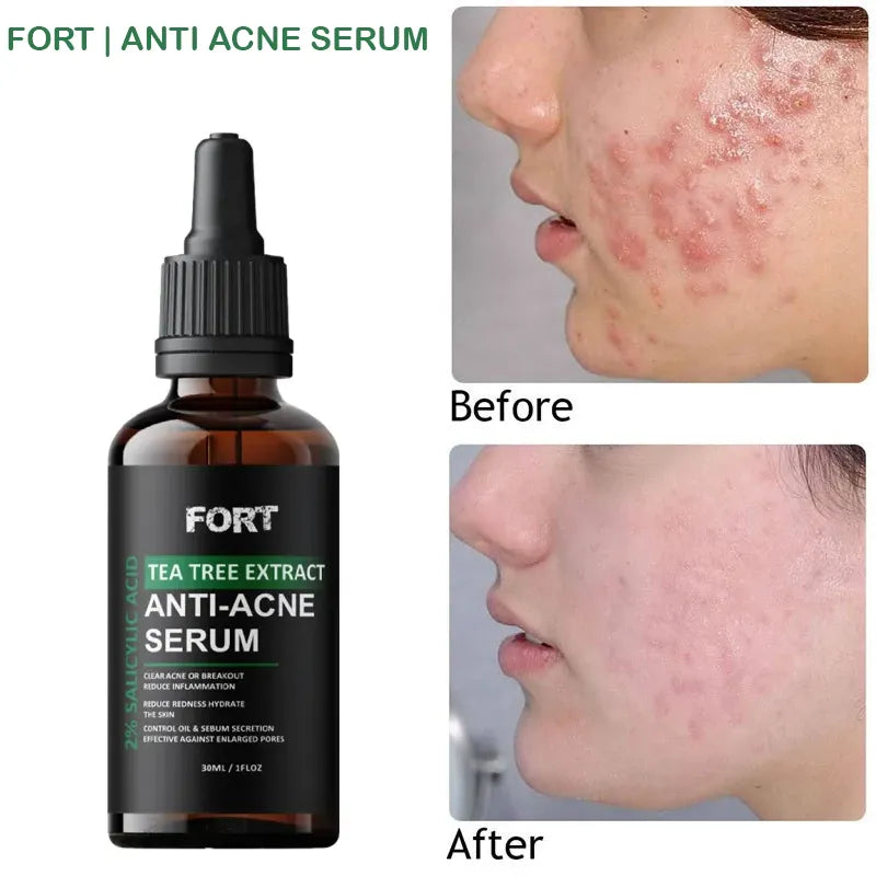 Acne Skin Care Products 30ml