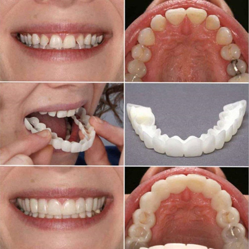Snap-on Smile Silicone Braces